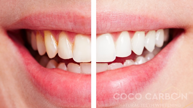 Zubná revolúcia krásny biely úsmev